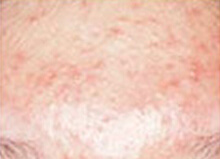 トレチノイン治療 施術前