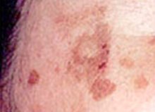 トレチノイン治療 施術前