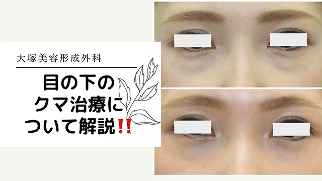 【目の下のクマ治療】について宮多先生に解説して頂きました！