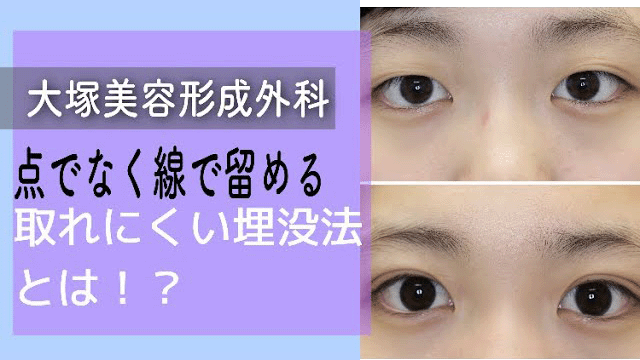 【二重整形　埋没法】大塚美容形成外科の点でなく線で留める埋没法とは？？