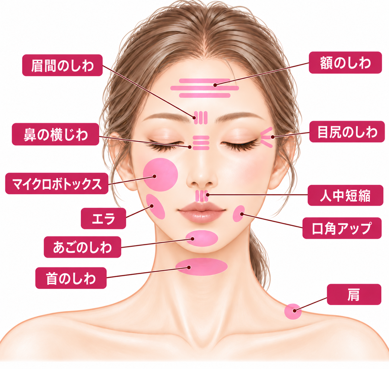 額・眉間・目尻・鼻・頬・口元・エラ・あご・首・肩などのボトックス施術部位（クリニック提供）