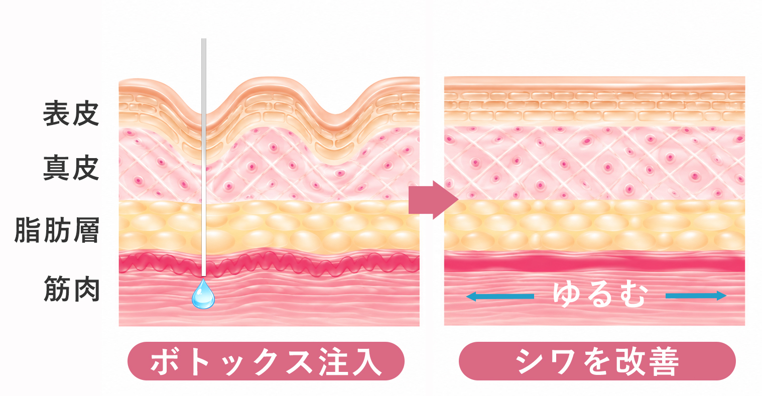 ボトックス注入後に筋肉がゆるみ、しわが改善する仕組みを示した断面図（クリニック提供）