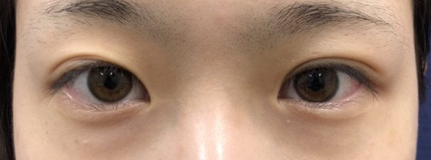 症例2 目元 術前
