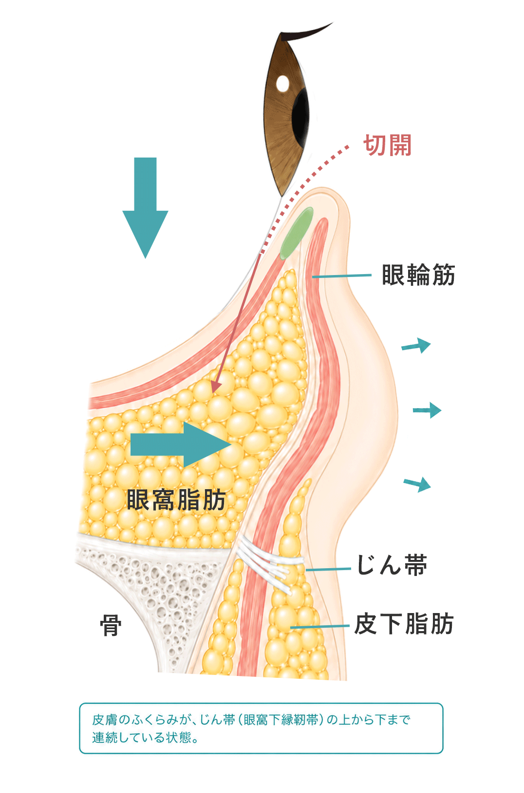 下瞼脱脂(経結膜脱脂)でまぶたの裏側から眼窩脂肪を取り除く仕組みの断面図(クリニック提供)