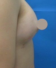 症例4｜20代 右 術後2か月