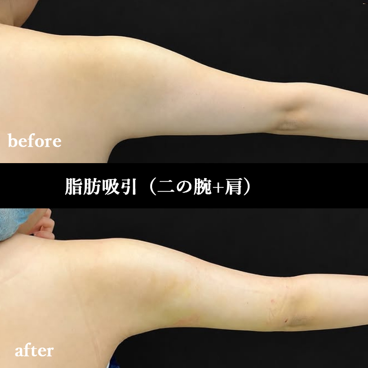 二の腕+肩の脂肪吸引 症例(術前・術後)