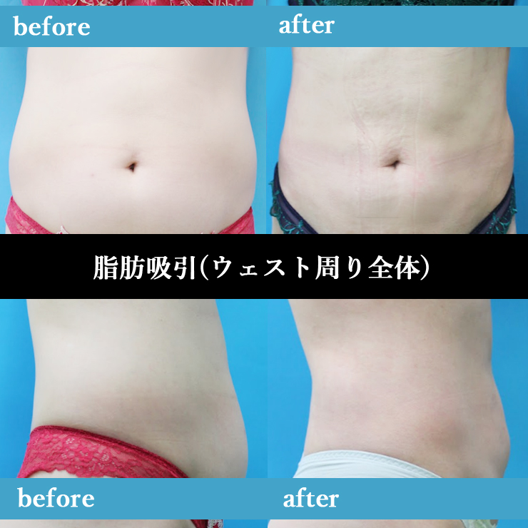 ウェスト周り全体の脂肪吸引 症例(術前・術後)