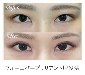 フォーエバーブリリアント埋没法 症例写真