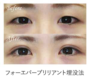 フォーエバーブリリアント埋没法 症例写真