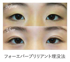 フォーエバーブリリアント埋没法 症例写真