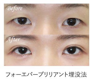 フォーエバーブリリアント埋没法 症例写真