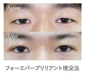 フォーエバーブリリアント埋没法 症例写真