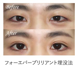 フォーエバーブリリアント埋没法 症例写真