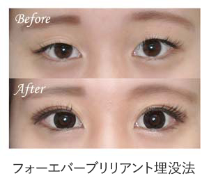 フォーエバーブリリアント埋没法 症例写真