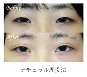 ナチュラル埋没法 症例写真