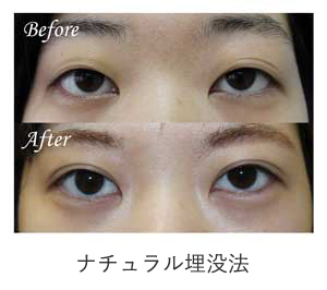 ナチュラル埋没法 症例写真