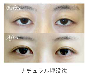 ナチュラル埋没法 症例写真