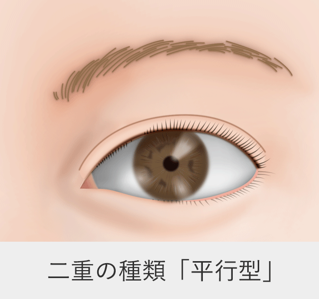 二重の種類ー平行型