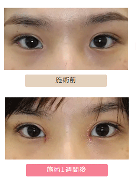 目頭切開術後1週間