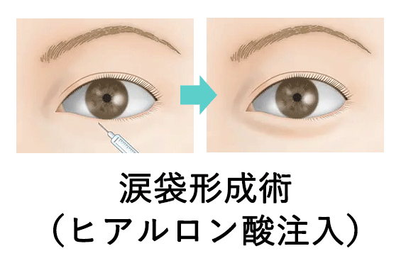 涙袋形成術 （ヒアルロン酸注入）