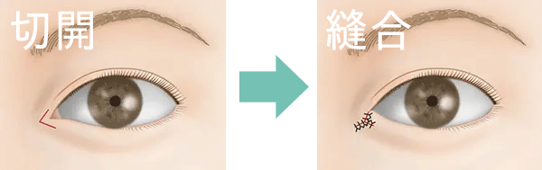 蒙古襞形成vy法とは