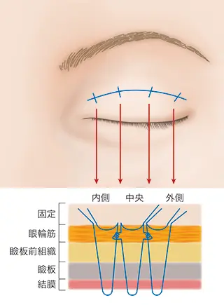 連結法