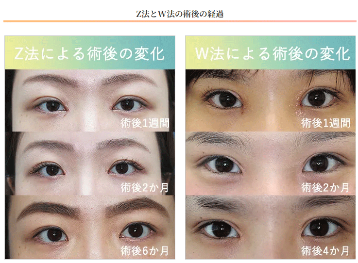 目頭切開術後の変化