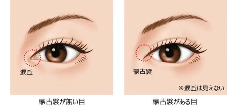 蒙古襞のある目、蒙古襞のない目