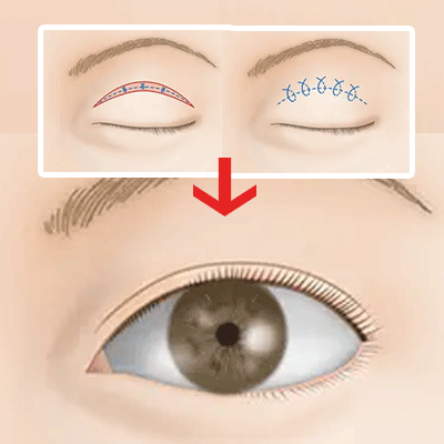 そもそも二重切開って取れるの？
