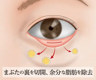 下まぶたたるみ取り（脱脂法）の施術方法